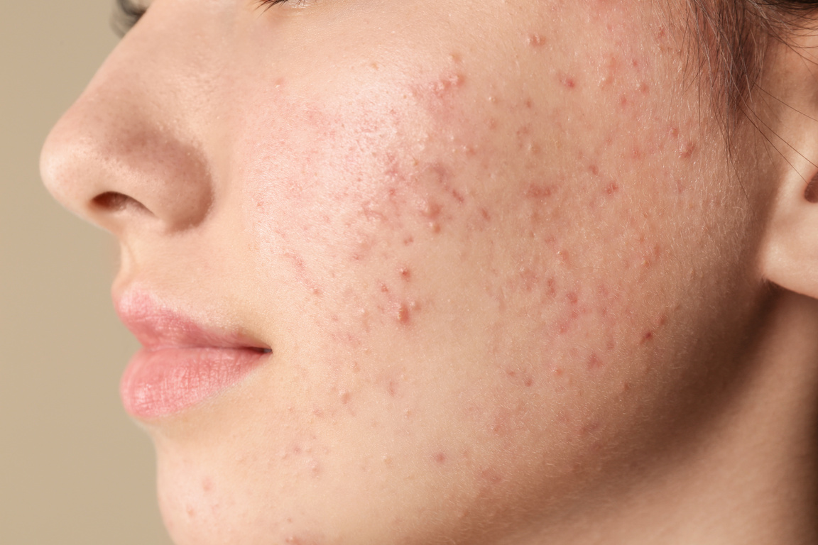 Teenage Girl with Acne Problem on Beige Background, Closeup